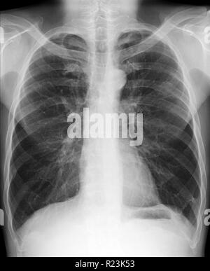 X-ray medizinische Bild - Brust und Lunge Stockfoto