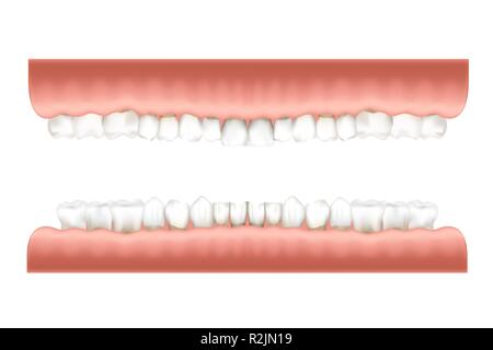 Gebiss Infografik Charts mit realistischen menschlichen Zähnen in rosa Gummi auf die oberen und unteren Kollimatorblenden auf Weiß Stock Vektor