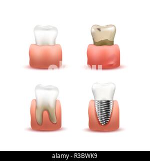 Satz von Weißen gesunden, kranken und verrottet, künstliches Implantat Zahn in Gummis auf Weiß Stock Vektor