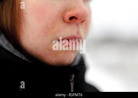 Close up portrait einer hübschen frau schöne Lippen Herpes Virus infiziert Stockfoto