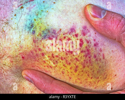 Gequetschte wunde Verletzungen am menschlichen Körper. Patient zeigen verletzte Körper mit großen paintful Hämatom. Hipster Filter. Stockfoto