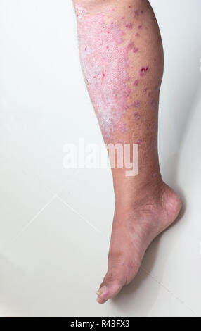 Das Bein des Menschen mit Psoriasis gefüllt, auf den Boden gelegt. Krankheiten, die durch Störungen des Lymphsystems verursacht. Psoriasis ist eine Hauterkrankung. Stockfoto