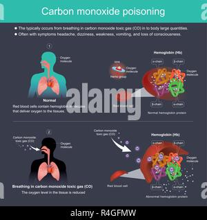 Die tritt in der Regel von der Atmung in Kohlenmonoxid giftiges Gas (CO) im Körper große Mengen. Oft mit Symptomen Kopfschmerzen, Schwindel, Schwäche, Stock Vektor