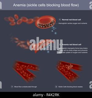 Hämoglobine Formen unsachgemäß lange Ketten, die Zelle seine Sichelform und verhindert eine ausreichende Aufnahme von Sauerstoff und Nutrien Stock Vektor