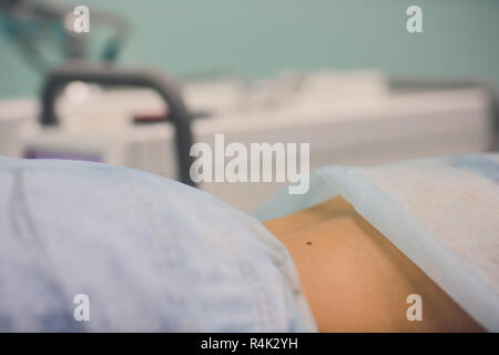 Entfernung von gutartigen Tumoren in der kosmetischen Salon. Die Verwendung von flüssigem Stickstoff in der Dermatologie. Stockfoto