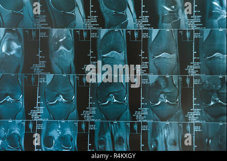 Magnetic Resonance Imaging geschossen von kniegelenk closeup MRT-Aufnahme Stockfoto