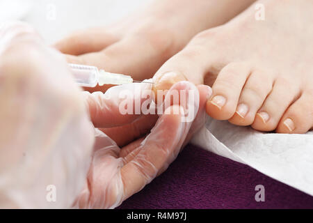 Schmerzlindernde Injektion chirurgische Entfernung von eingewachsenen Nagel. Injektion auf die Zehen des Fußes. der Arzt ein analgetikum Droge in der Frau Zehe einspritzt. Stockfoto