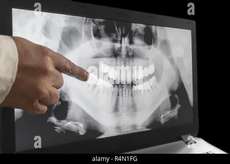 Ein Röntgen der Zähne mit einer Hand des Arztes Hexe, die auf eine fillinged Zahn. Stockfoto