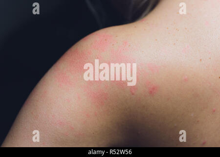 Close up Allergie Hautausschlag, um die Rückseite des menschlichen mit Dermatitis Problem der Ausschlag, Allergie Hautausschlag und gesundheitliches Problem. Stockfoto