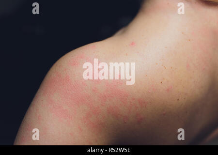 Close up Allergie Hautausschlag, um die Rückseite des menschlichen mit Dermatitis Problem der Ausschlag, Allergie Hautausschlag und gesundheitliches Problem. Stockfoto