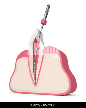 3D-Render von Zahn mit Endodontischen Datei im Zahnfleisch. Wurzelbehandlung Konzept. Stockfoto