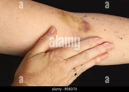 Ein hämatom auf dem Arm der Frau. Eine große Beule am Arm einer Frau Stockfoto