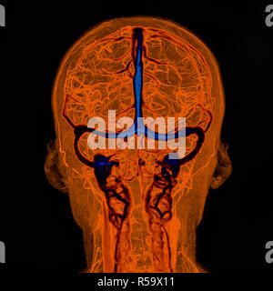 Intrakraniellen Blutgefäße, Abbildung auf einem farbigen Magnetresonanztomographie (MRT) Scan eines menschlichen Gehirn und seinen Intrakraniellen Blutgefäße basierend Stockfoto