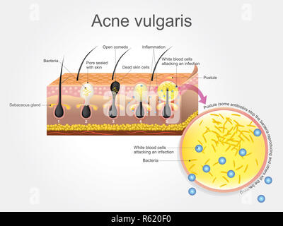 Akne Vulgaris Stockfoto