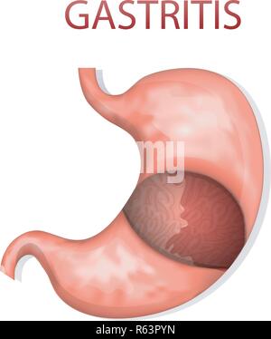 Abbildungen des Magens, Gastritis. Gastroenterologie. Gaster Stock Vektor