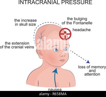 Abbildung: Symptome einer intrakraniellen Druck bei Kindern Stock Vektor
