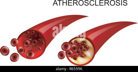 Abbildung: gesunde Arterie und Atherosklerose Atherosklerose. Stock Vektor