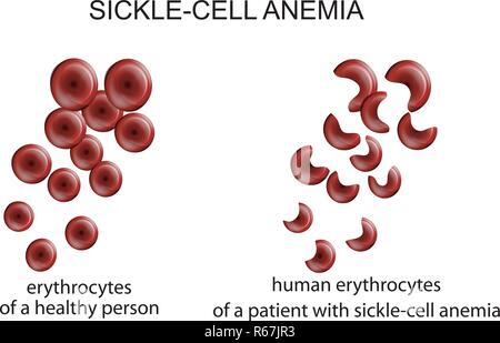 Abbildung von Blutzellen in die Krankheit Sichelzellenanämie Stock Vektor