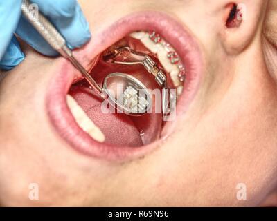 Prag, Tschechische Republik 28.09.2018. Die Hyrax (Hygienische schnelle Expander) Gebänderte konzipiert als oberer Bogen rapid palatal Expansion Gerät. Stockfoto