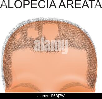Abbildung: Leiter der Person leidet unter Alopezie areata Stock Vektor
