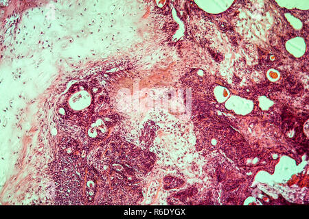 Gemischte Tumor der Ohrspeicheldrüse krankes Gewebe 100x Stockfoto