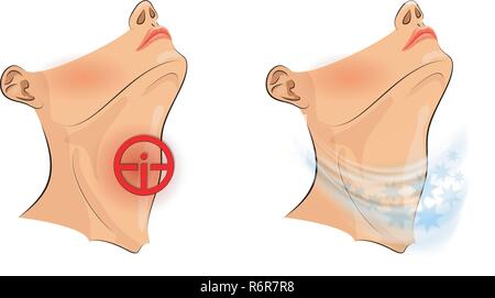 Abbildung: Halsschmerzen Halsschmerzen, Schmerzen Stock Vektor