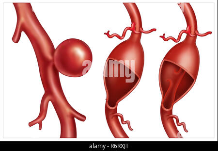 Schematische Darstellung von Typen von Aneurysmen, es ist die Erweiterung einer Arterie. Die Arten von Hirnaneurysmen sind: Sakulär, fusiform und sezieren. Stockfoto