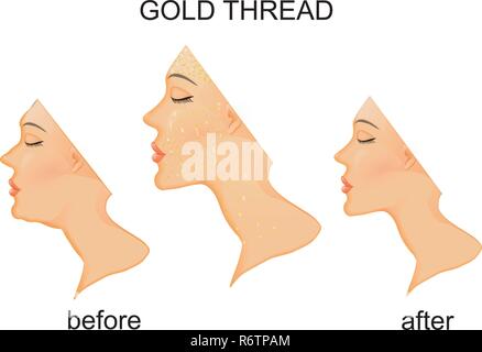 Abbildung: gesichtsverjüngung und Hals mit Gold thread. vor und nach dem Stock Vektor