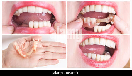 Zahnmedizinische Rehabilitation mit oberen und unteren Prothese, die vor und nach der Behandlung Stockfoto
