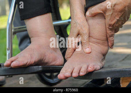 Ältere Frau geschwollene Füße drücken Sie die Taste Test auf Rollstuhl Stockfoto