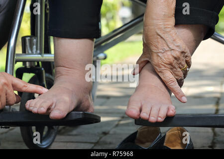 Ältere Frau geschwollene Füße drücken Sie die Taste Test auf Rollstuhl Stockfoto