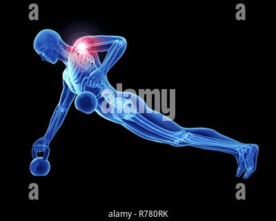 3D-gerenderte Abbildung: schmerzhafte Schultergelenk eines Athleten. Stockfoto