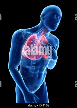 3D-gerenderte Abbildung: ein Mann mit einem entzündete Lunge. Stockfoto