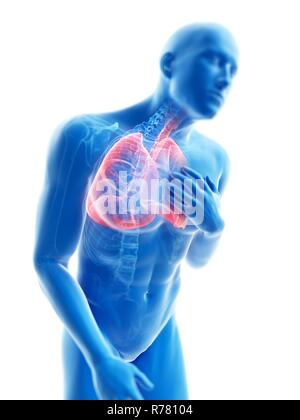 3D-gerenderte Abbildung: ein Mann mit einem entzündete Lunge. Stockfoto