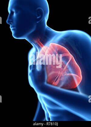 3D-gerenderte Abbildung: ein Mann mit einem entzündete Lunge. Stockfoto