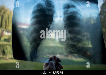 Lunge Röntgen, oder x-ray film Lunge Untersuchung durch Arzt Stockfoto