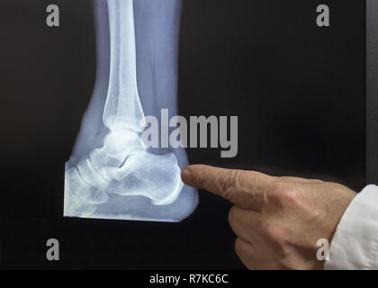 Eine xray einer Ferse mit einer Hand von Arzt Hexe, die auf einen Bruch Stockfoto