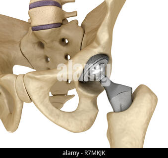 Hüftgelenkersatz-Implantat in den Knochen des Beckens installiert. Medizinisch genaue 3D-Illustration Stockfoto