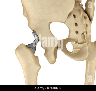 Hüftgelenkersatz-Implantat in den Knochen des Beckens installiert. Medizinisch genaue 3D-Illustration Stockfoto