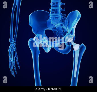 Hüftgelenkersatz-Implantat in den Knochen des Beckens installiert. Röntgenblick. Medizinisch genaue 3D-Illustration Stockfoto