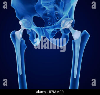 Hüftgelenkersatz-Implantat in den Knochen des Beckens installiert. Röntgenblick. Medizinisch genaue 3D-Illustration Stockfoto