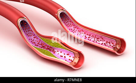 Blutgefäße: Normal und Cholesterin Schiff beschädigt. 3D render Stockfoto