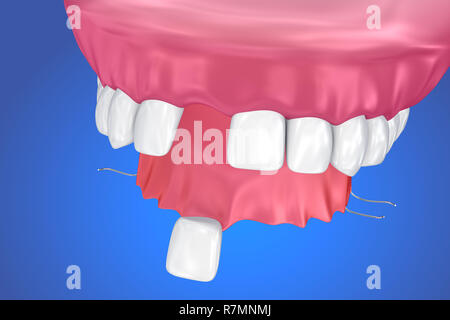 Einzelne fehlende Zahn - herausnehmbare Teilprothese. 3D-Darstellung Stockfoto