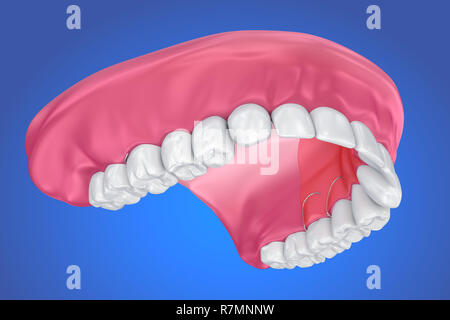Einzelne fehlende Zahn - herausnehmbare Teilprothese. 3D-Darstellung Stockfoto