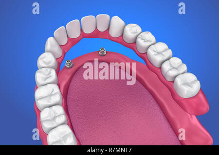 Feste Brücke auf Implantaten. Medizinisch genaue 3D-Darstellung Stockfoto