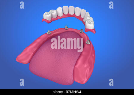 Feste Brücke auf Implantaten. Medizinisch genaue 3D-Darstellung Stockfoto