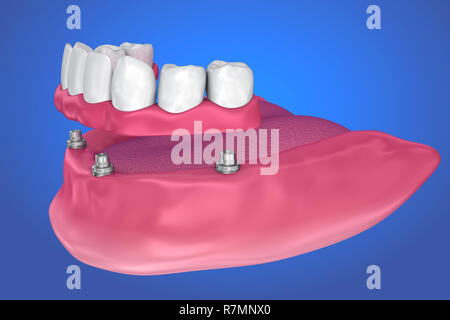 Feste Brücke auf Implantaten. Medizinisch genaue 3D-Darstellung Stockfoto
