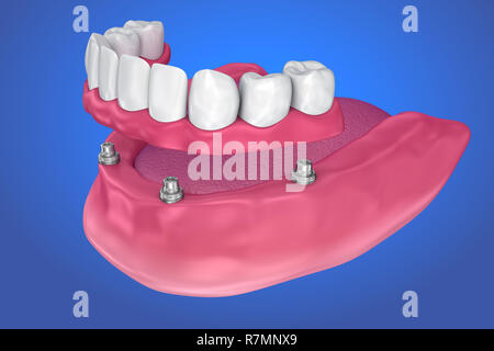 Feste Brücke auf Implantaten. Medizinisch genaue 3D-Darstellung Stockfoto