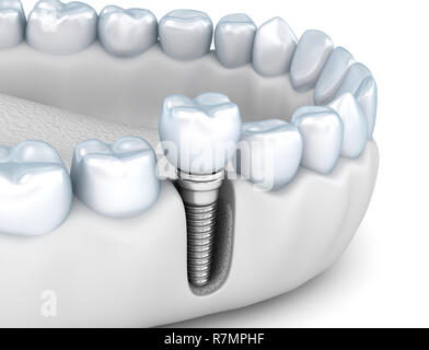 Zahn instalation Prozess Implantat, Medizinisch genaue 3D-Abbildung weiß Stil Stockfoto