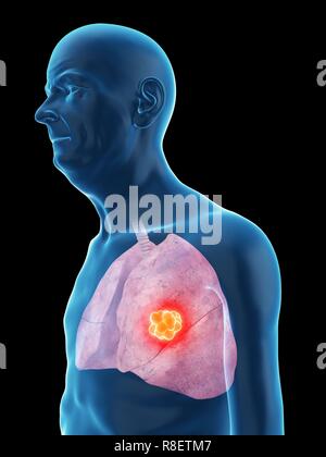 Abbildung: Lungenkrebs ist ein alter Mann. Stockfoto